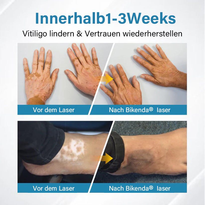 Bikenda® EVENA Vitiligo Lichttherapie Gerät