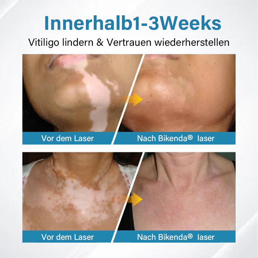 Bikenda® EVENA Vitiligo Lichttherapie Gerät