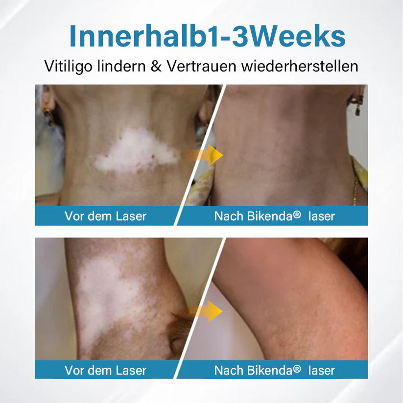 Bikenda® EVENA Vitiligo Lichttherapie Gerät