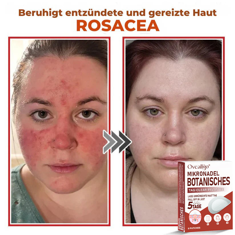 Oveallgo® MikroNadel Botanisches Tag-Clear-Pflaster PRO 🇩🇪 Hergestellt in der Germany