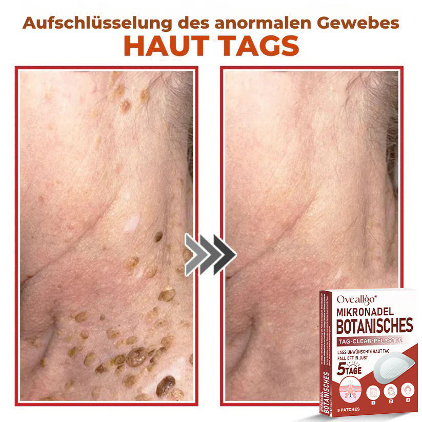 Oveallgo® MikroNadel Botanisches Tag-Clear-Pflaster PRO 🇩🇪 Hergestellt in der Germany