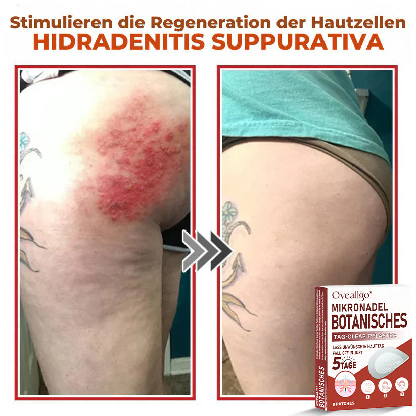 Oveallgo® MikroNadel Botanisches Tag-Clear-Pflaster PRO 🇩🇪 Hergestellt in der Germany