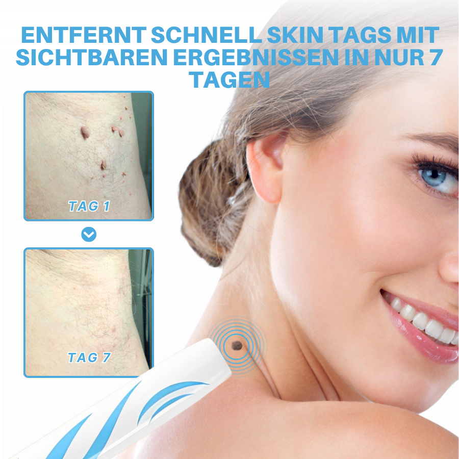 Fivfivgo® Schmerzfreier Stift zur Entfernung von Hautmarkierungen zu Hause Pro