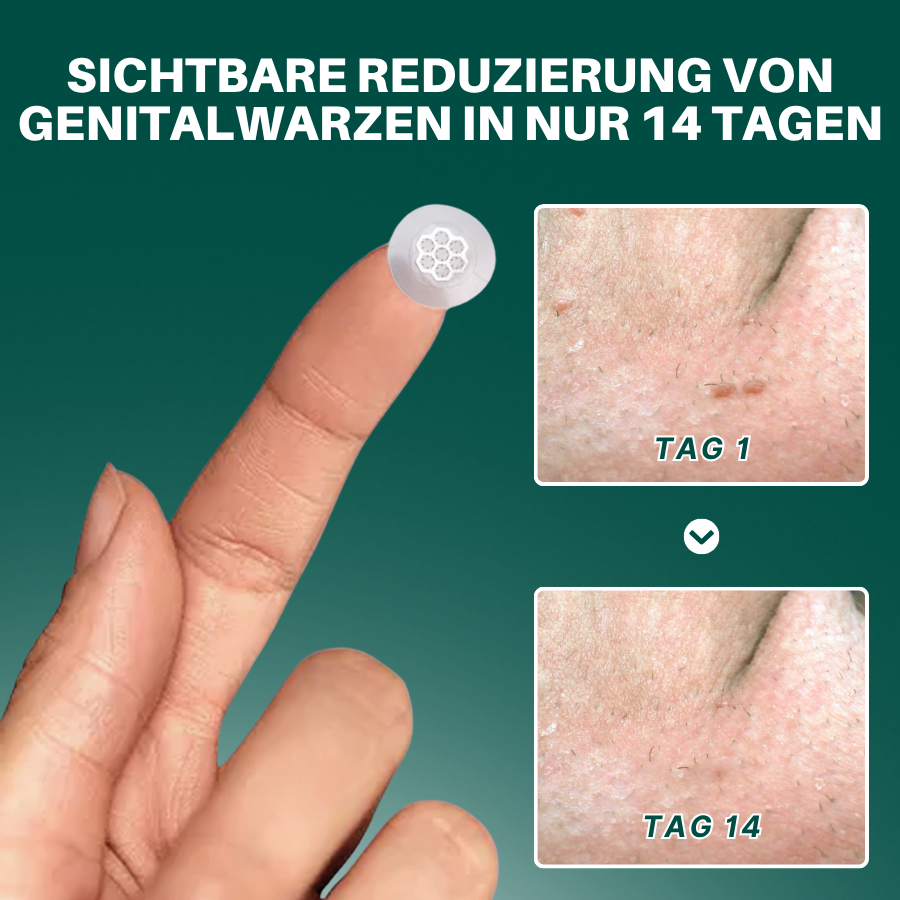 Fivfivgo® Magnesium Mikropin HPV Genitalien Warzen Entfernung Patch Pro