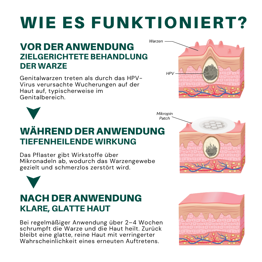 Fivfivgo® Magnesium Mikropin HPV Genitalien Warzen Entfernung Patch Pro