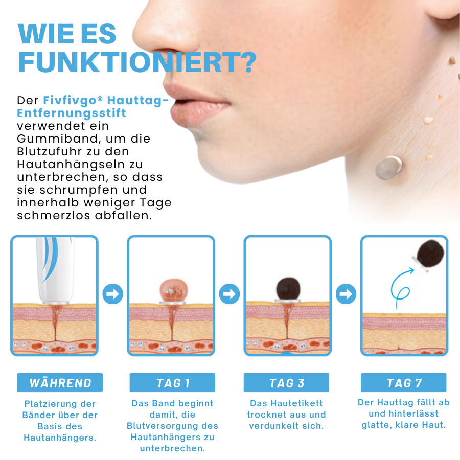 Fivfivgo® Schmerzfreier Stift zur Entfernung von Hautmarkierungen zu Hause Pro