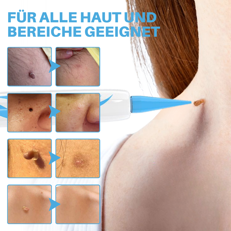 Fivfivgo® Schmerzfreier Stift zur Entfernung von Hautmarkierungen zu Hause Pro
