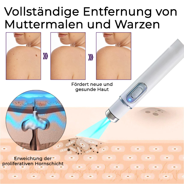Bikenda® Maulwurf- und Warzenentfernungs-Laserset