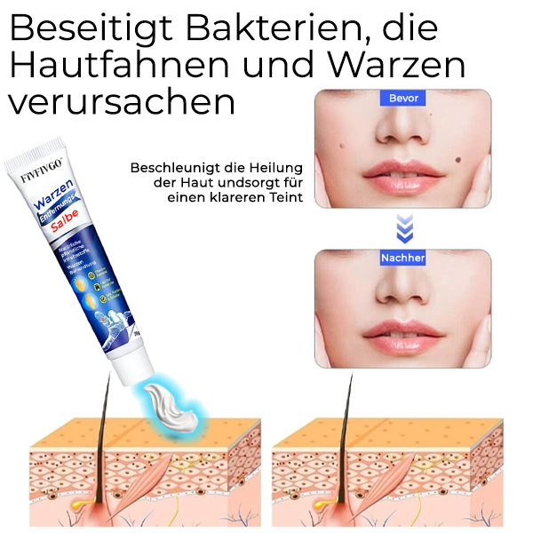 Bikenda® Maulwurf- und Warzenentfernungs-Laserset