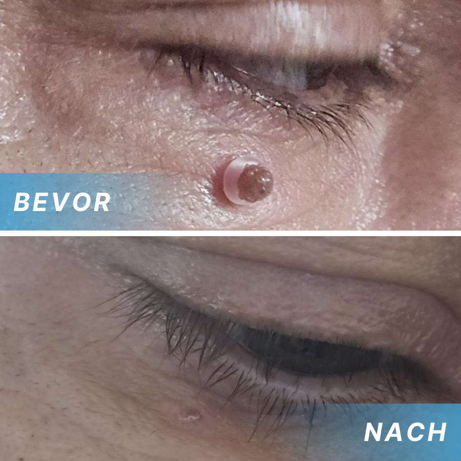 Fivfivgo® Schmerzfreier Stift zur Entfernung von Hautmarkierungen zu Hause Pro