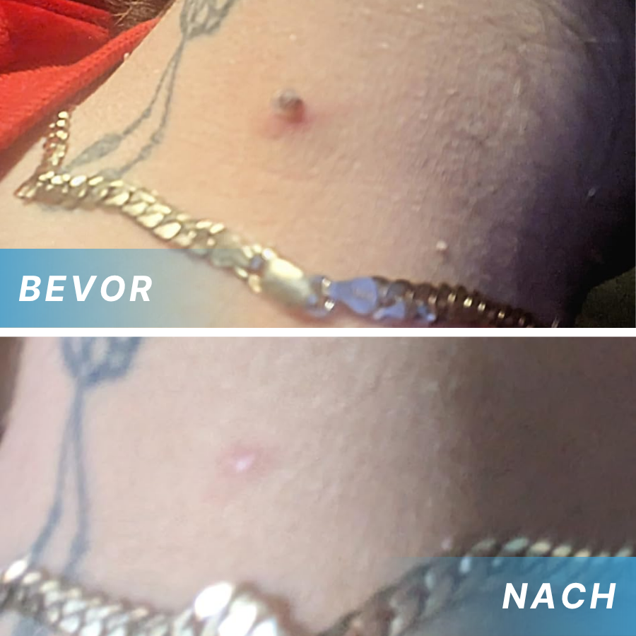 Fivfivgo® Schmerzfreier Stift zur Entfernung von Hautmarkierungen zu Hause Pro