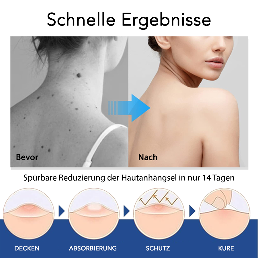 Fivfivgo® ClearTag Warzenentferner: Pflaster versiegeln & heilen