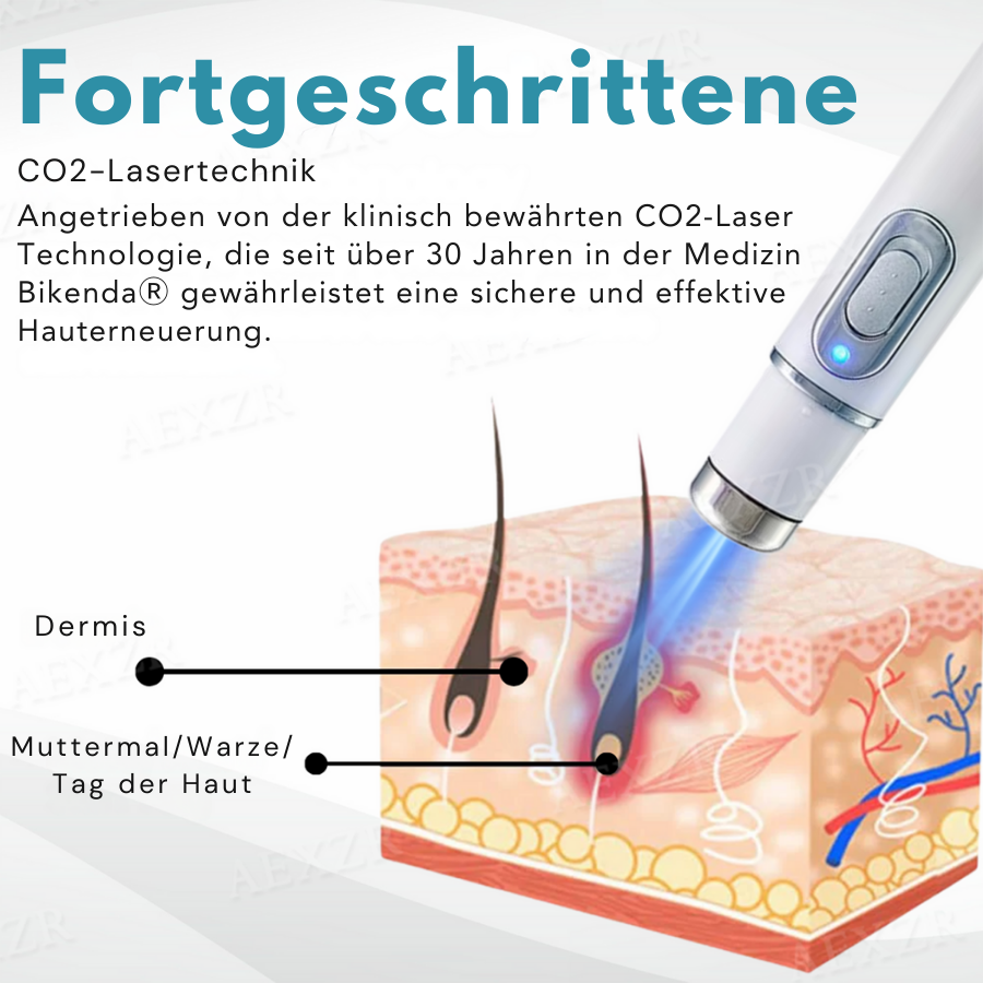 Bikenda® Nicht-invasiv Leberfleck- und Warzenentfernungs-Laserstift Exklusiv