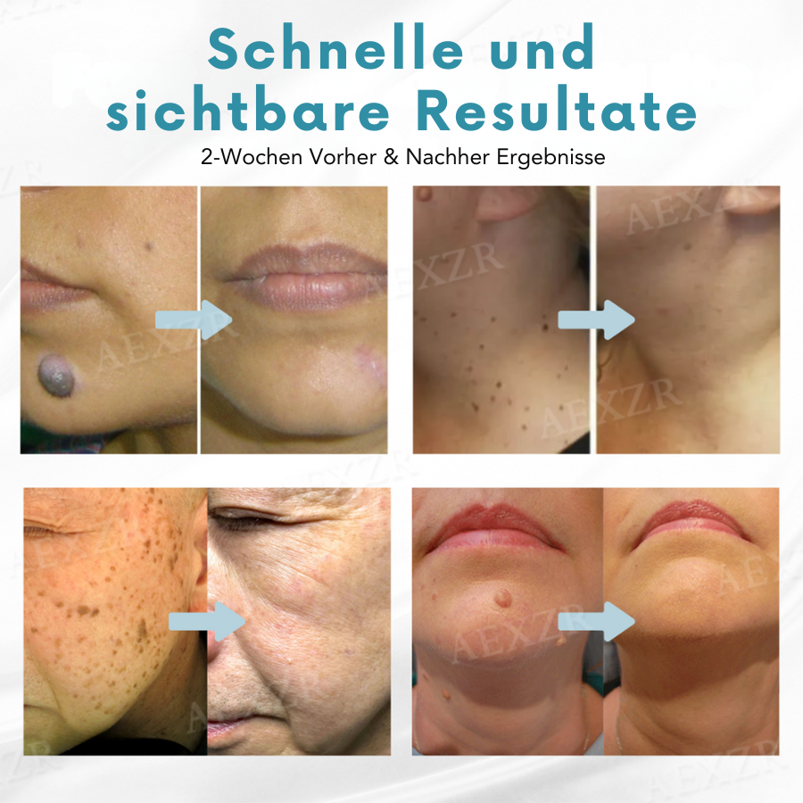 Bikenda® Nicht-invasiv Leberfleck- und Warzenentfernungs-Laserstift Exklusiv