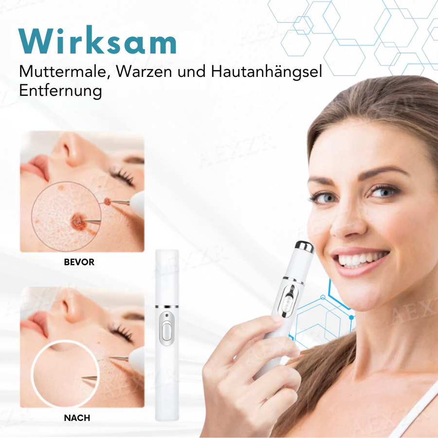 Bikenda® Nicht-invasiv Leberfleck- und Warzenentfernungs-Laserstift Exklusiv