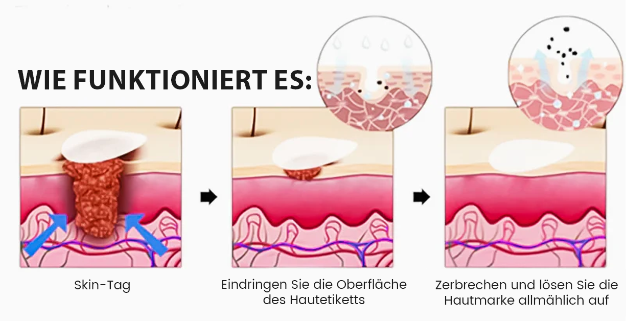 ✅Official Store: Oveallgo® Magnesium MicroPin Target & Clear Patch zur Entfernung von Warzen