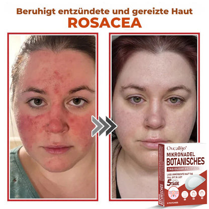 Oveallgo® MikroNadel Botanisches Tag-Clear-Pflaster PRO 🇩🇪 Hergestellt in der Germany
