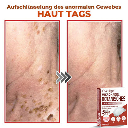 Oveallgo® MikroNadel Botanisches Tag-Clear-Pflaster PRO 🇩🇪 Hergestellt in der Germany