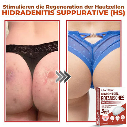 Oveallgo® MikroNadel Botanisches Tag-Clear-Pflaster PRO 🇩🇪 Hergestellt in der Germany