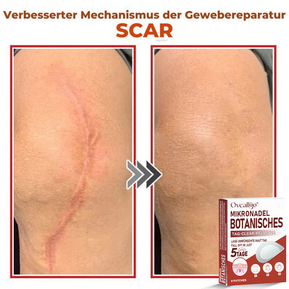 Oveallgo® MikroNadel Botanisches Tag-Clear-Pflaster PRO 🇩🇪 Hergestellt in der Germany