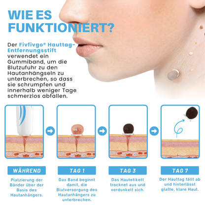 Fivfivgo® Schmerzfreier Stift zur Entfernung von Hautmarkierungen zu Hause Pro