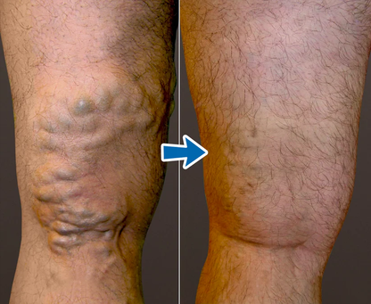Cvreoz® VenoAid Varizen-Lösungsspray Pro