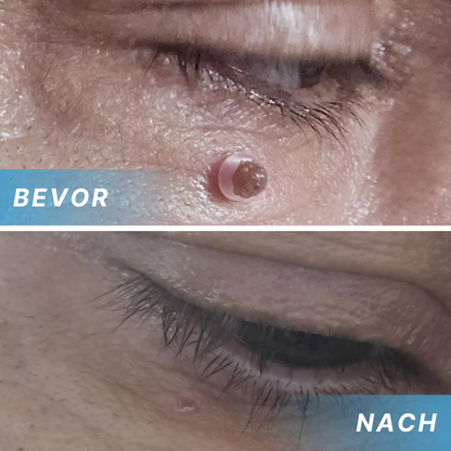 Fivfivgo® Schmerzfreier Stift zur Entfernung von Hautmarkierungen zu Hause Pro