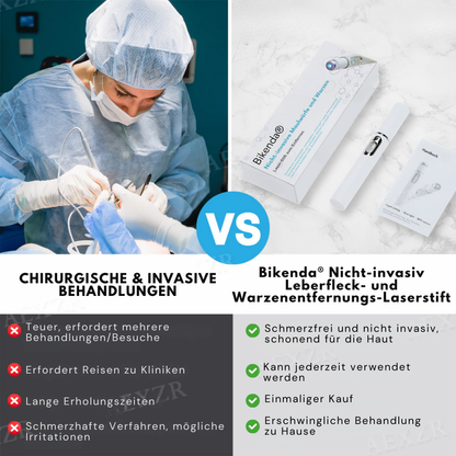 Bikenda® Nicht-invasiv Leberfleck- und Warzenentfernungs-Laserstift Turbo